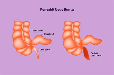 Anak dengan gejala usus buntu, bolehkah diberikan Paracetamol? Dokter jelaskan keamanan serta dosis yang tepat